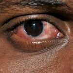 Conjunctivitis (pink eye) affects the outer membrane of the eyeball and the inner eyelid. PHOTO: SUPPLIED